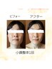 【大人気の新メニュー】くいしばり◎小顔整体×美容鍼灸　60分　定価¥13,200