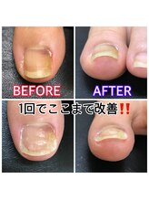 キラキラフット神領 ありが接骨院/巻き爪/フットケア