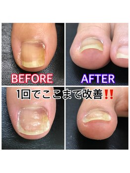 キラキラフット神領 ありが接骨院/巻き爪/フットケア