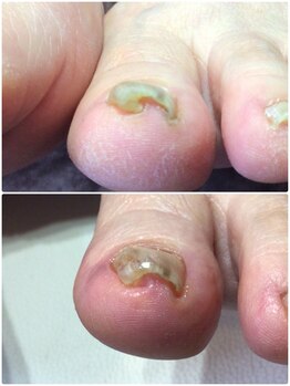 モアクリスタル(More Crystal)/巻き爪補正