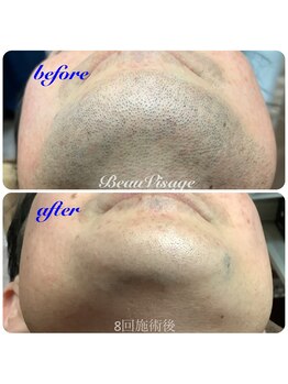 ビューヴィサージュ(Beau Visage)/メンズ顔脱毛