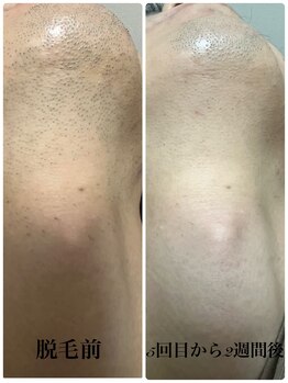 ルナソル 昭島店(LUNASOL)/髭脱毛