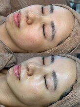 プライベートエステティックサロン アメジスト(AMETHYST)/ララピールbeforeAfter　２