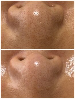 ナナラ(NANALA)/毛穴黒ずみ、ザラつき