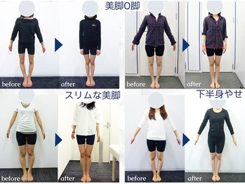 美デザイン 池袋店(美.design)/☆美脚O脚+骨盤矯正Before-After