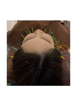 トイ鍼灸接骨院(TOY鍼灸接骨院)/●美容鍼