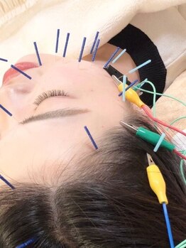 瑞 鍼灸院の写真/【完全個室の美容鍼灸サロン】『小顔×肌質改善』お悩みに合わせた美容鍼で血行を改善し肌トラブルケア◎