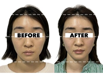 カドモリ 心斎橋(KADOMORI)/小顔矯正×美容鍼3回【美容鍼】