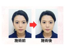飯能ひだまり整骨院/小顔矯正（１回施術後）
