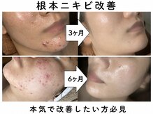 バリマ ビューティー(Bali Ma'beauty)の雰囲気（《諦めずに一度ご相談を》ニキビケアに全力で向き合う高評価店☆）