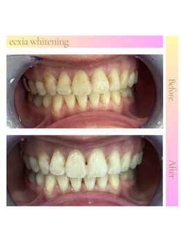 エクシアホワイトニング 仙台一番町店/ホワイトニングビフォーアフター