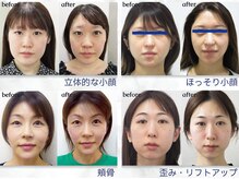 美デザイン 池袋店(美.design)/☆小顔矯正Before-After