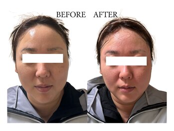 ヨサパーク サノン(YOSA PARK Sanon)/お顔の浮腫み取りましょう！