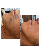 ゆでたまご/ヒゲ脱毛