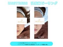 施術後は見違えるお肌に♪