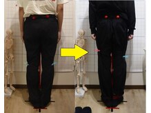 豊田まえやま接骨院/Ｏ脚矯正実績　２０代男性