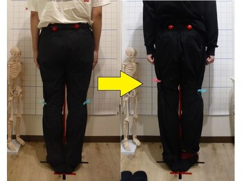 豊田まえやま接骨院/Ｏ脚矯正実績　２０代男性