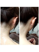 サロン ピューパ(Salon pupa)/花嫁様うなじ　Before→After