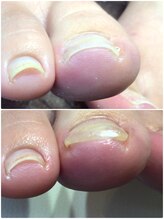 モアクリスタル(More Crystal)/巻き爪補正