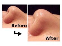 エステティックサロン キュビア(Cubia)/イチゴ鼻解消★鼻パック