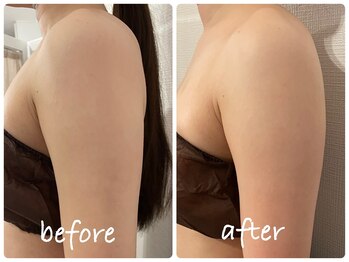 ルーシーガーデン(LUCY GARDEN)/ダウンタイムケア インディバ