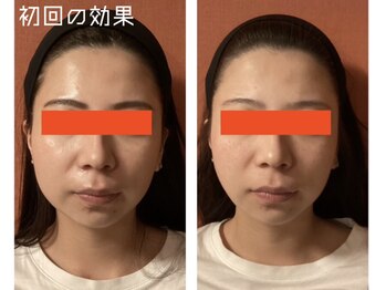 ロイヤリティ(ROYALTY)/小顔贅沢セット