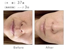 ルナスーリヤ 表参道店/ハーブピーリング