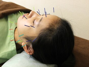 いなほ はりきゅう整骨院 東新宿/美容鍼施術/手順3