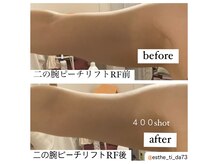 ティーダ(Ti-Da)/たるみ改善！脂肪にアプローチ