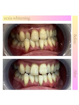 エクシアホワイトニング 仙台一番町店/ホワイトニングビフォーアフター