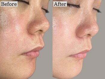 あすはれ/フェイシャルWaxの効果