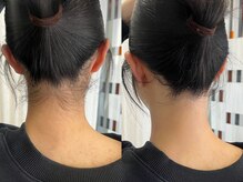 シロ(Shiro)/うなじのデザイン脱毛