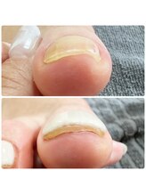 アンドネイル(+ and Nail)/巻き爪/フットケア/フットネイル