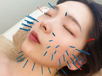 ナオル整体 新宿院(NAORU整体)の写真/【NEW!小顔美容鍼60分¥11000→¥7500】リフトアップ/小顔/浮腫み解消!美容鍼メニュー導入キャンペーン実施中