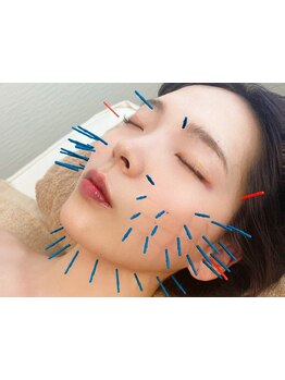 鍼灸施術を受けたい