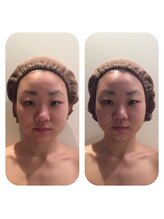 ブルームーン コルギアンドエステティック(Blue moon)/お顔のコルギのbefore after