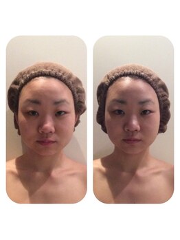 ブルームーン コルギアンドエステティック(Blue moon)/お顔のコルギのbefore after