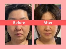 リライブ 亀有店(Re:Lives)の雰囲気（レモンボトル&レッドショットで30代～からの小顔美肌を実現♪）