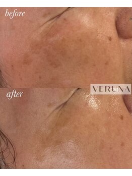 アトワ(A toi)/ハーブピーリング(棘あり)