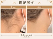 ジョリエストワ(Joliesse toi)の雰囲気（襟足脱毛をして後ろから見られても恥ずかしくない姿に！）