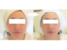 サロンドエステケイワイ(de KY)/フェイシャル☆小顔・タルミ改善