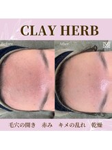 スリジエ ボーテ(cerisierBEAUTE)/敏感肌をノーマル肌に改善☆