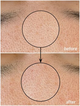 毛穴専科/ワックス脱毛メンズok/沖縄/那覇