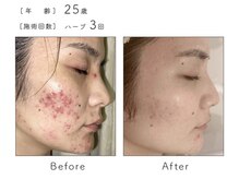 ルナスーリヤ 表参道店/ハーブピーリング