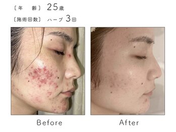 ルナスーリヤ 表参道店/ハーブピーリング