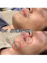 プリマプリート 大垣店/メンズ・ヒゲ脱毛