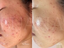 ルアナ(LUANA)/グレーズソフトピール