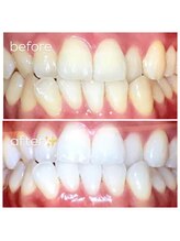 エクシアホワイトニング 津駅前店/お客様ビフォーアフター