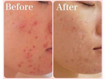 トータルビューティサロン クイーン(Queen)/●肌荒れのお悩み●