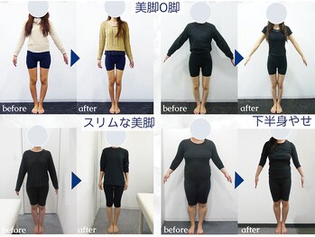 美デザイン 池袋店(美.design)/☆美脚O脚+骨盤矯正Before-After